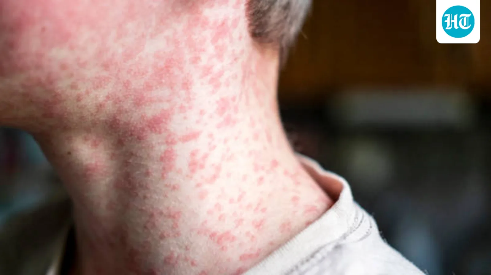 Understanding Skin Rashes in Children: Expert Insights