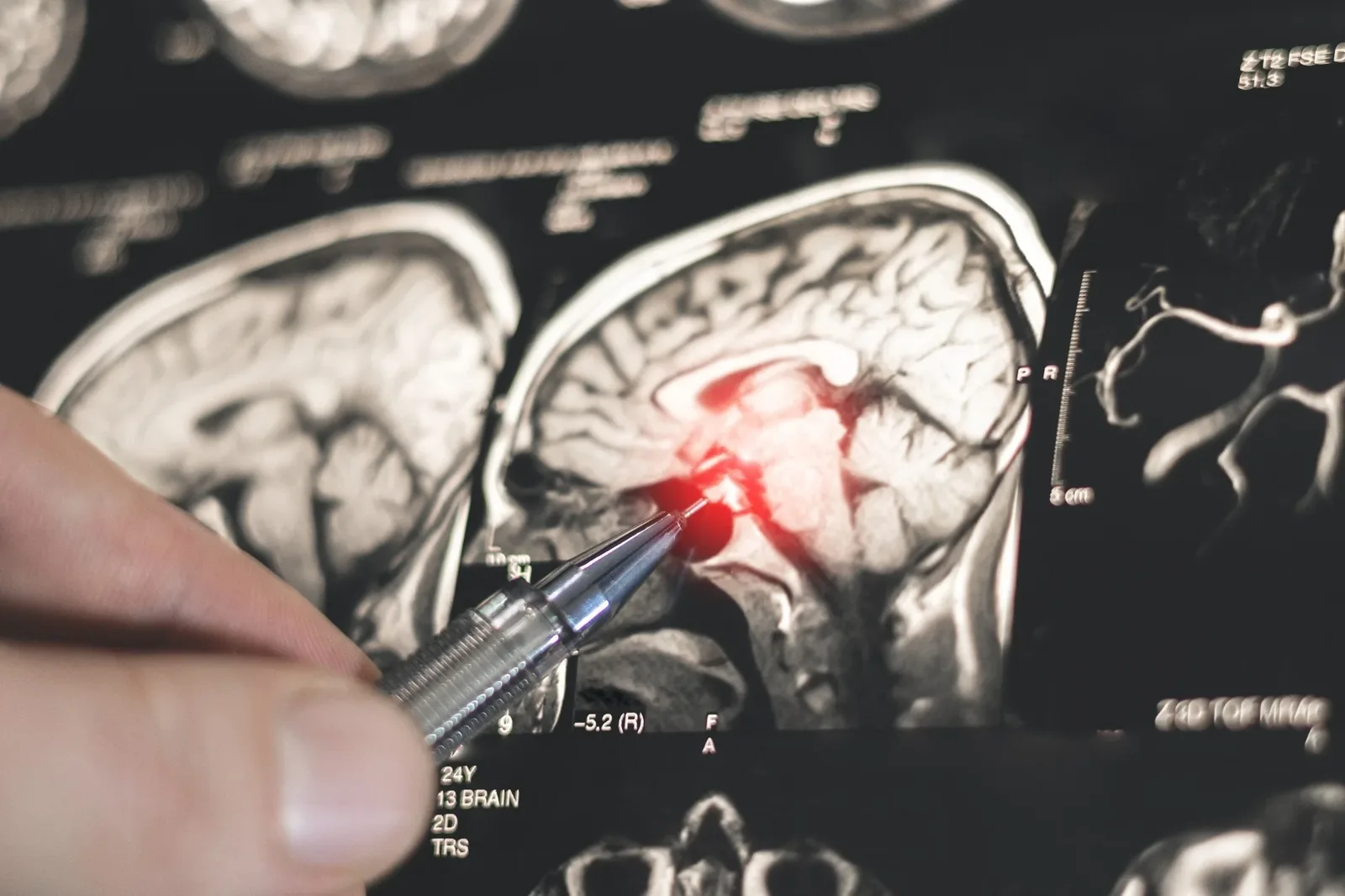 AI EpiScreen ने दौरे और कार्यात्मक दौरे में 81% सटीकता प्राप्त की