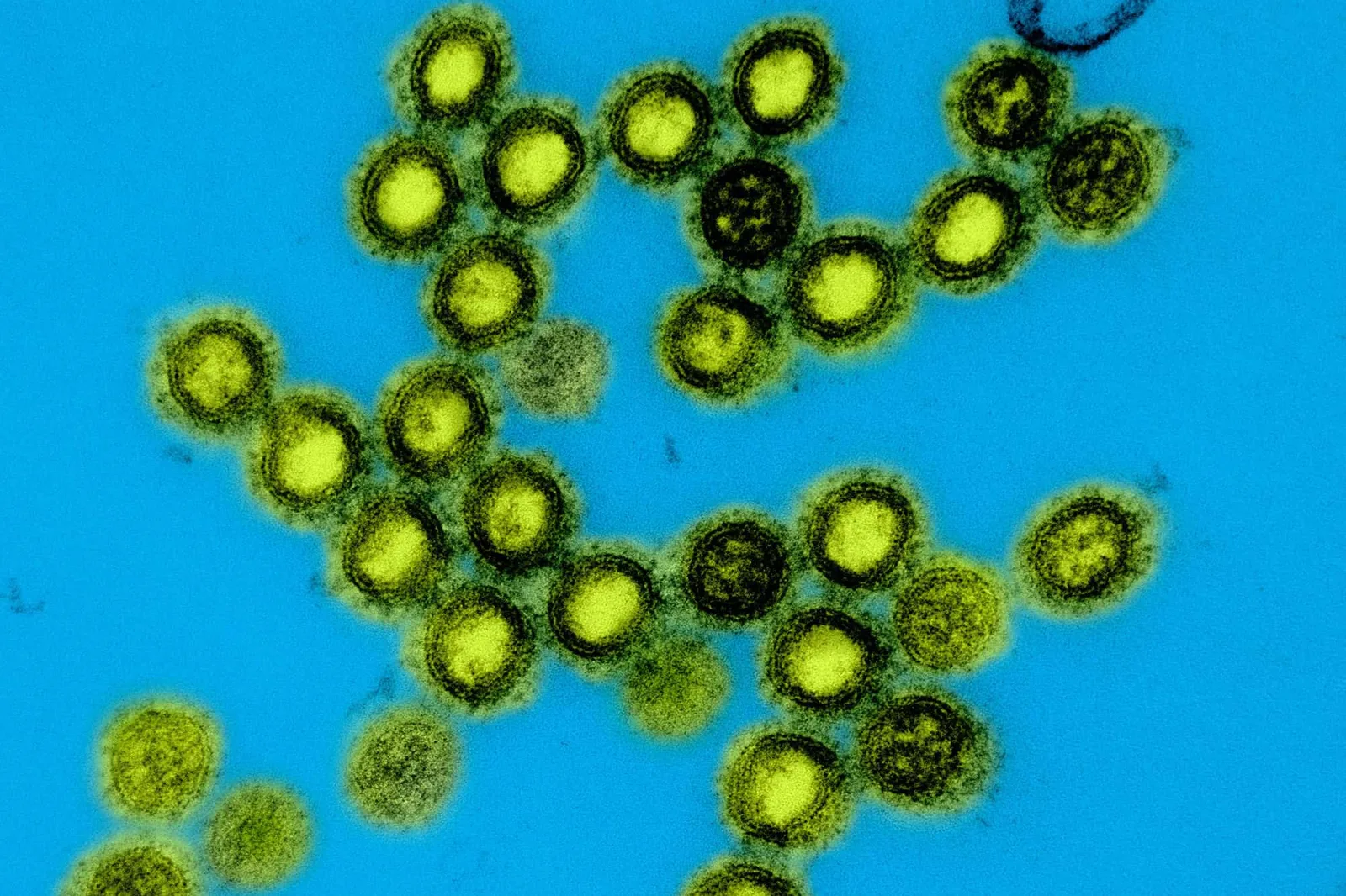Study Reveals Link Between Respiratory Viruses and Hospital Admissions