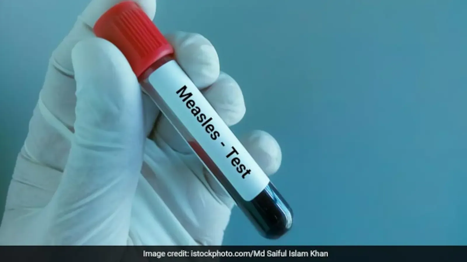 Measles Resurgence: Over 4,000 Cases Reported in the US by October 2026