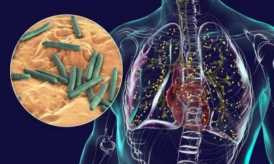 Study Reveals Distinct Microbiome Changes in Long Covid Patients