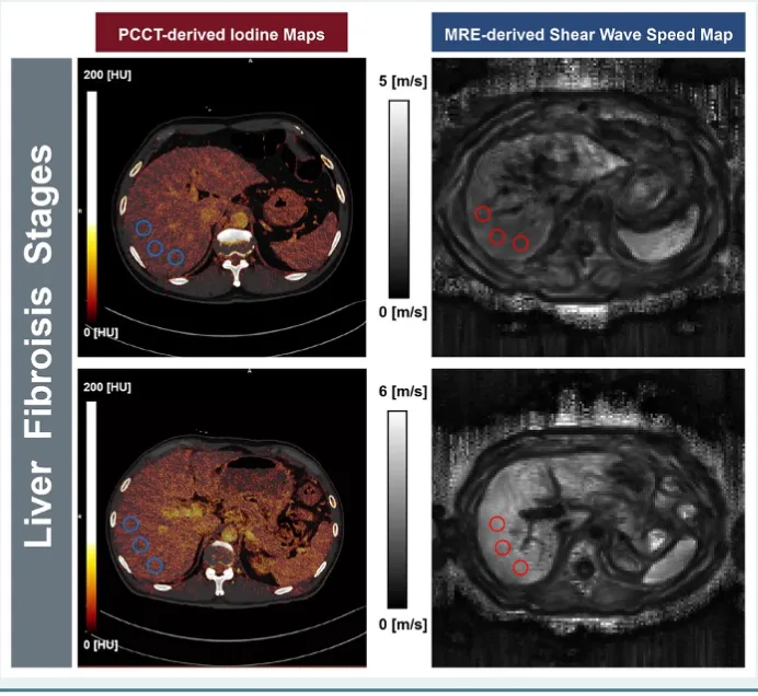 Elastography Enhances Liver Fibrosis Detection in Thalassaemia Patients